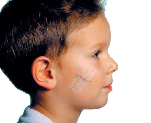 SUTURE 3M™ STERI-STRIP™ – Image 2