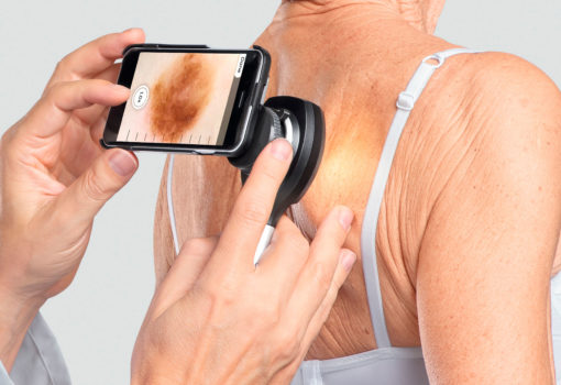 COQUE D'ADAPTATION DERMATOSCOPE HEINE NC2 POUR IPHONE